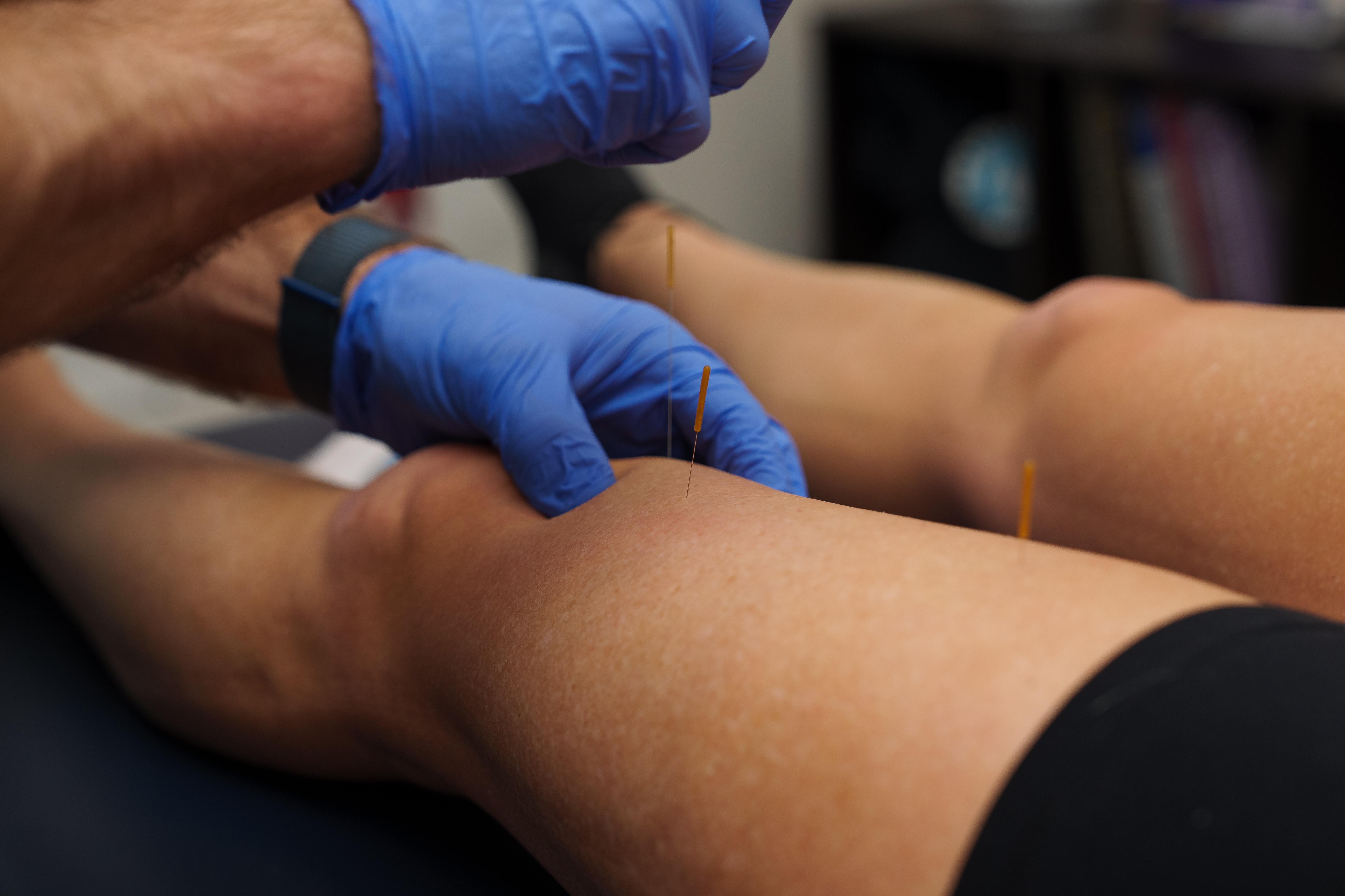 dry needling example